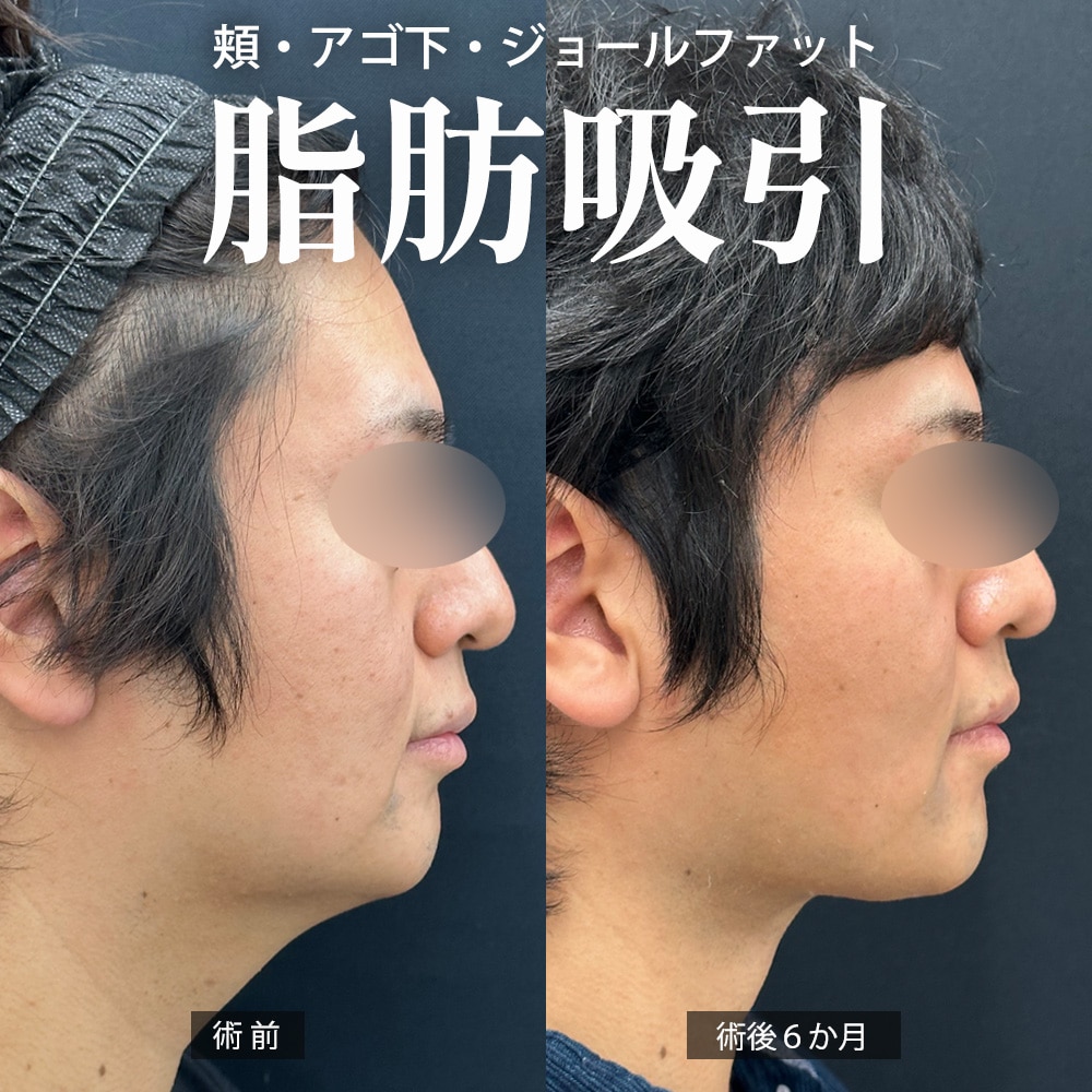 顔の脂肪吸引 症例2
