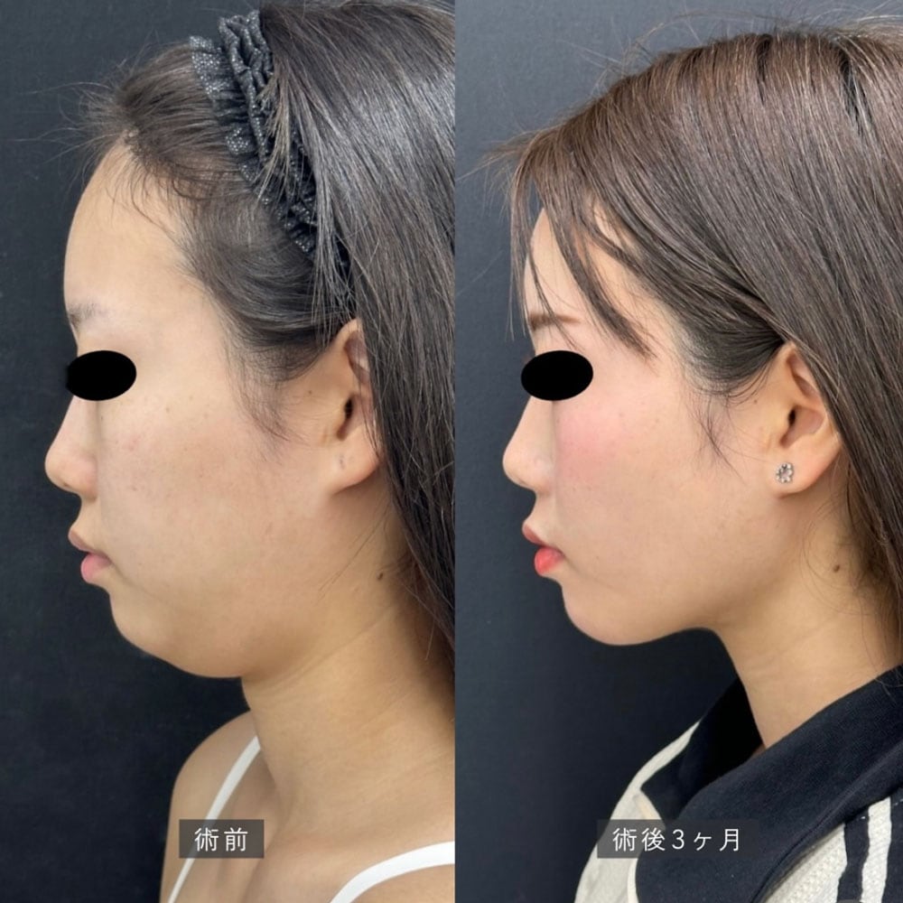 國久医師 脂肪吸引症例1