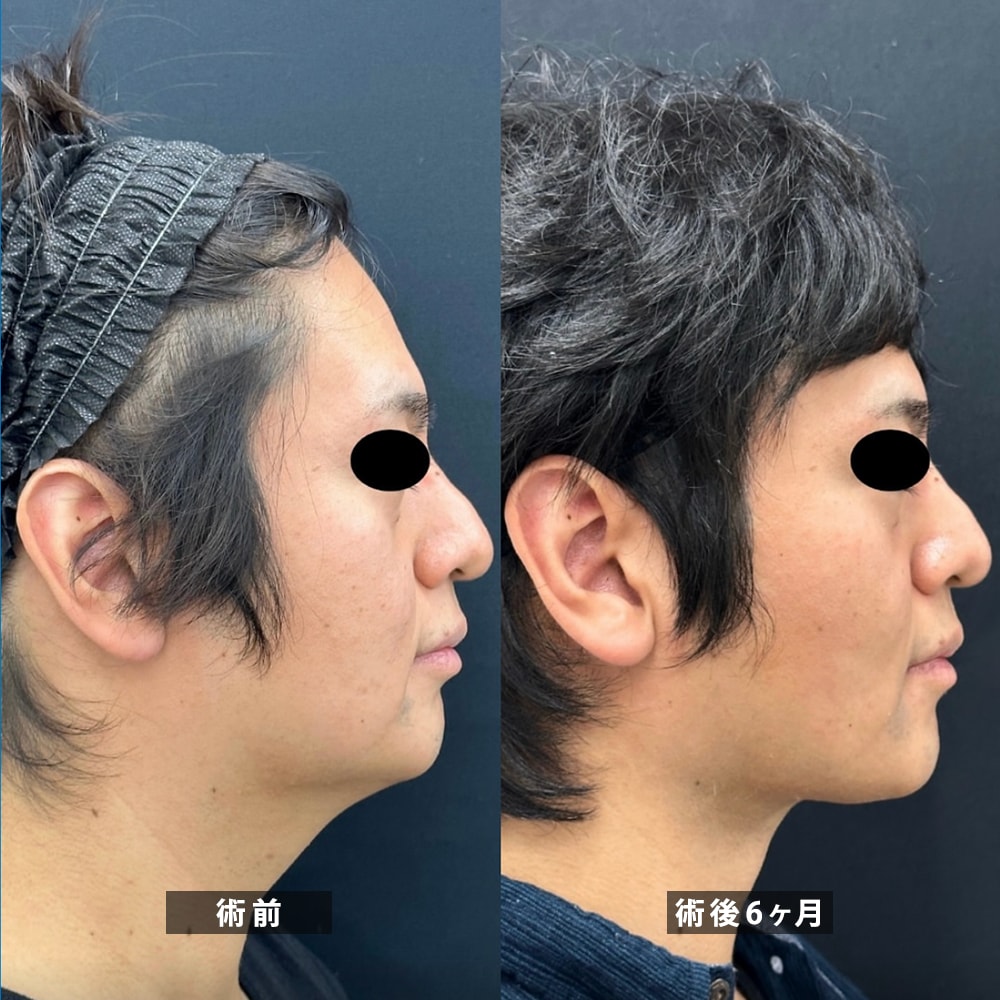 國久医師 脂肪吸引症例2