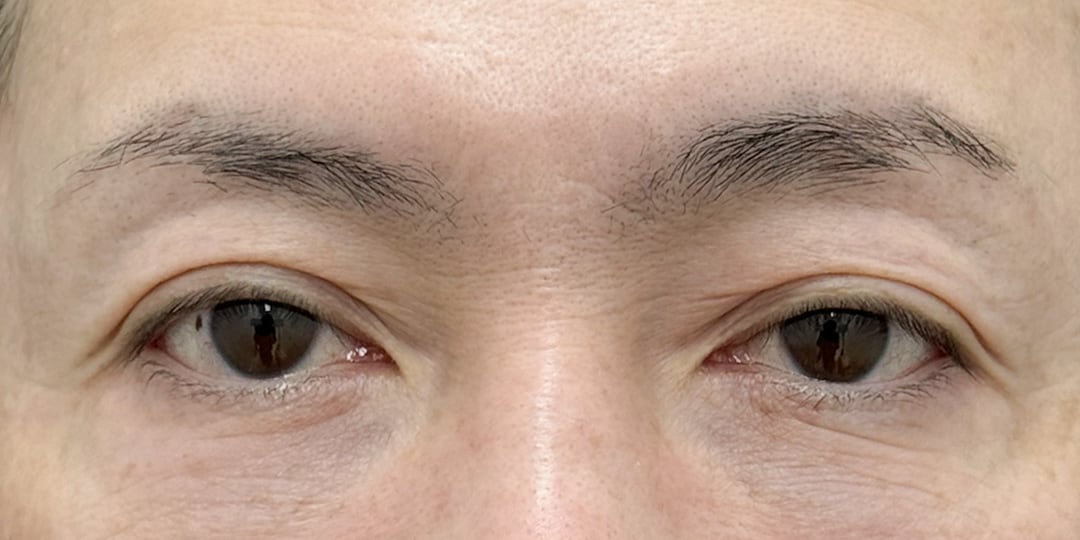 切らない眼瞼下垂 症例3 術前