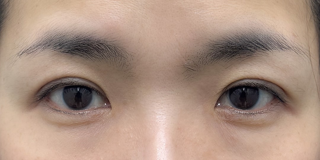 目元若返り 症例1 術後