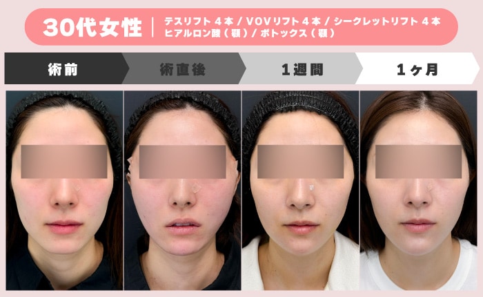 30代女性の糸リフトダウンタイム経過症例（術前・術直後・1週間・1ヶ月）