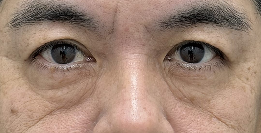 裏ハムラ法 症例1 術前