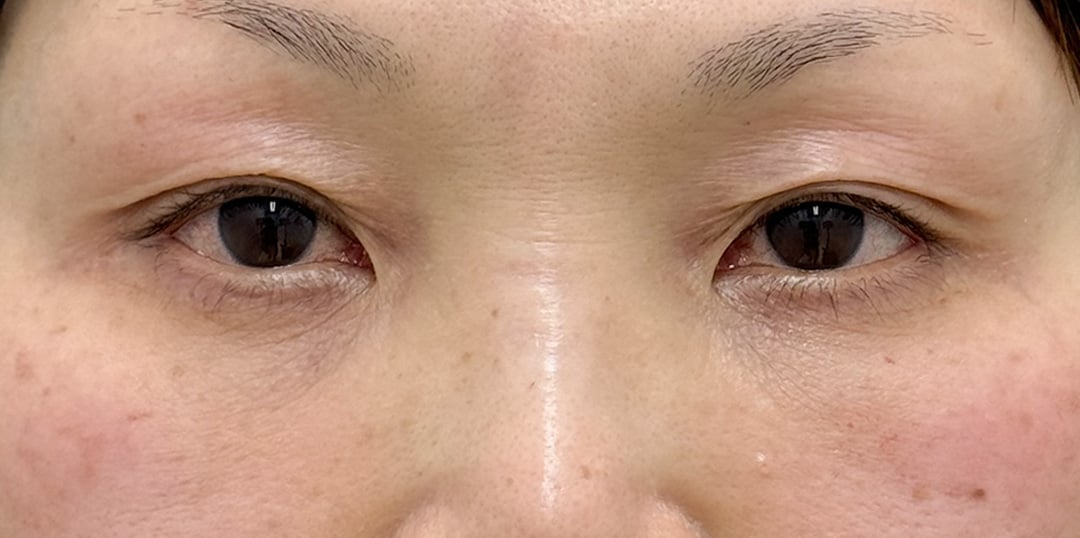 裏ハムラ法 症例4 術後