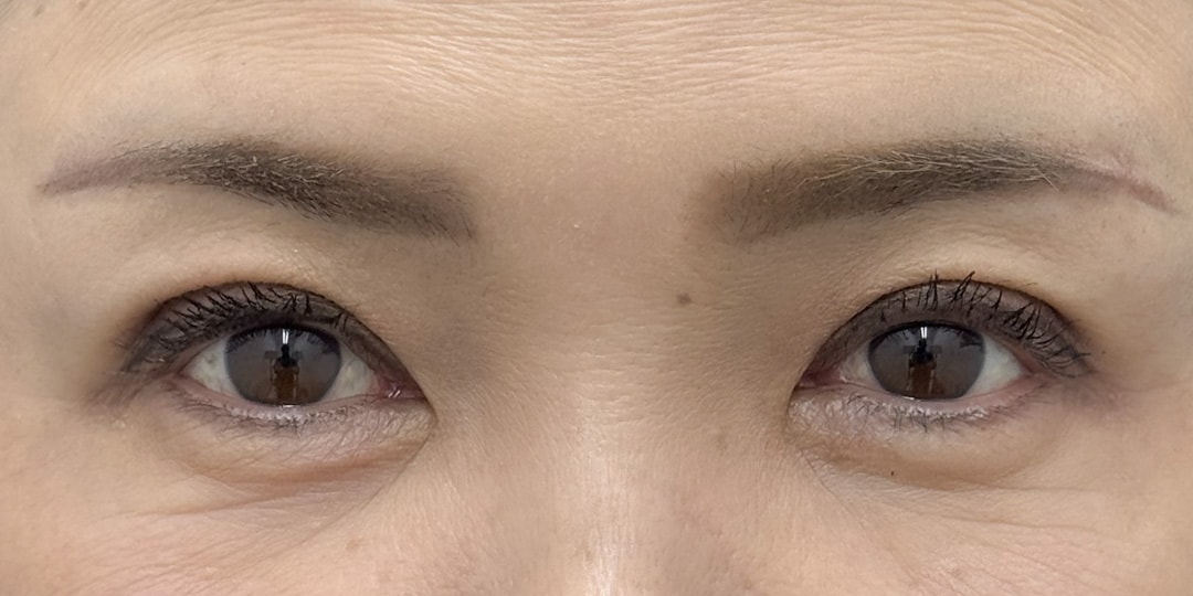 切らない眼瞼下垂 症例1 術後