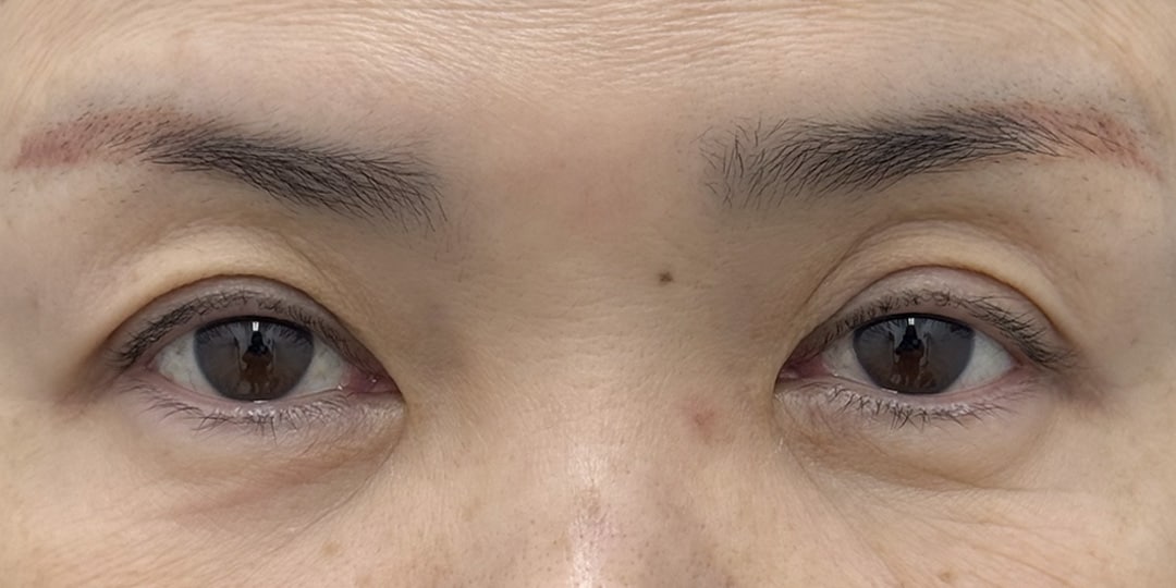 切らない眼瞼下垂 症例1 術前