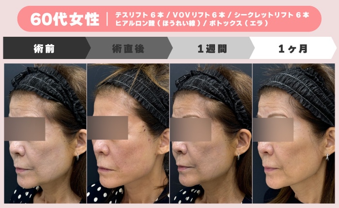60代女性の糸リフトダウンタイム経過症例（術前・術直後・1週間・1ヶ月）