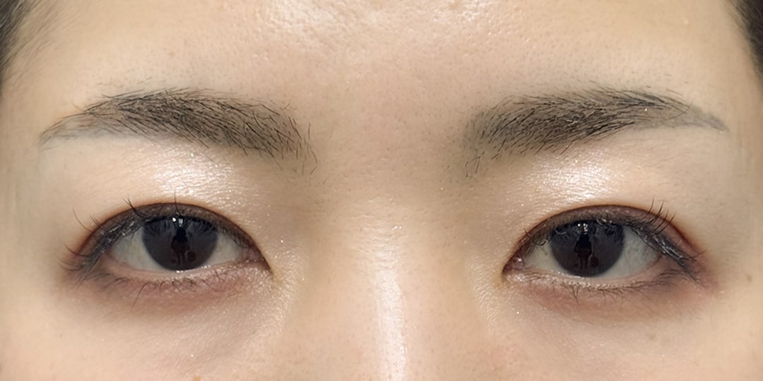 切らない眼瞼下垂 症例4 術後