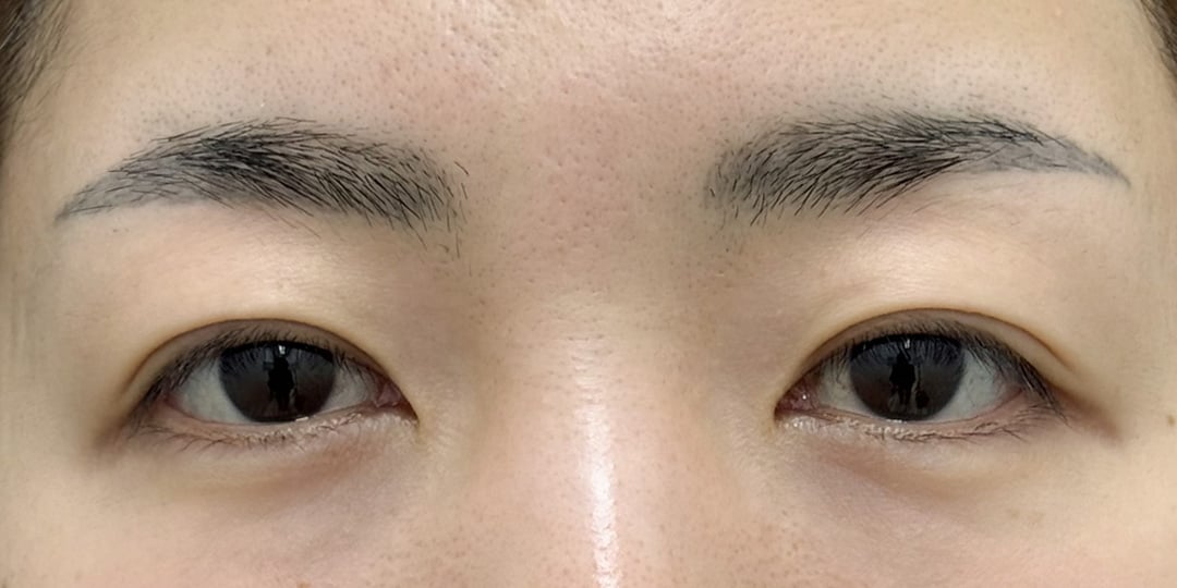 切らない眼瞼下垂 症例4 術前