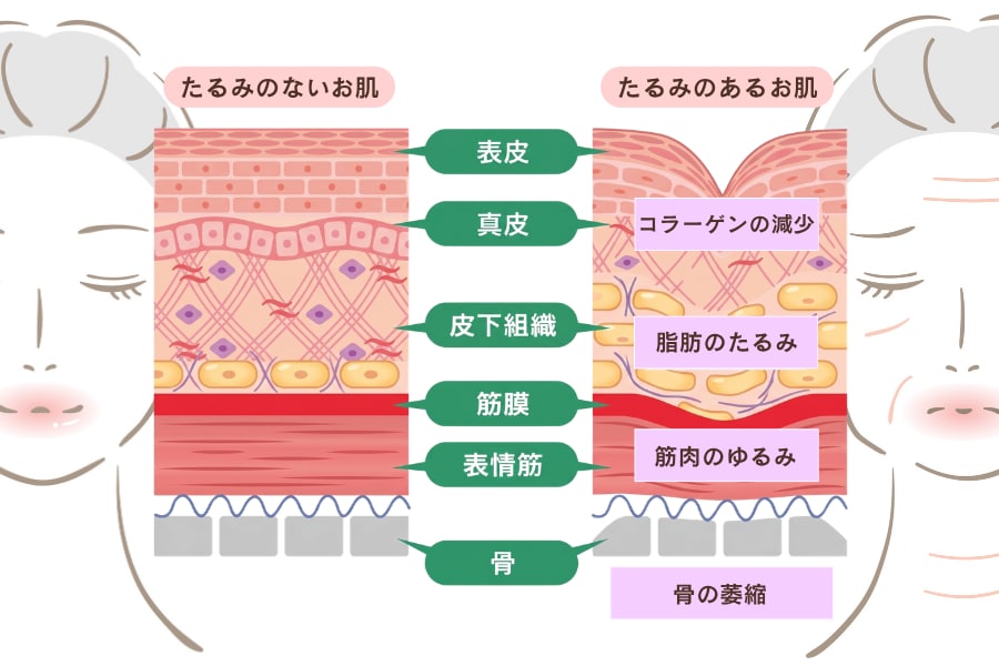 肌の奥で起きている、たるみの原因となる「土台の衰え」<br />
