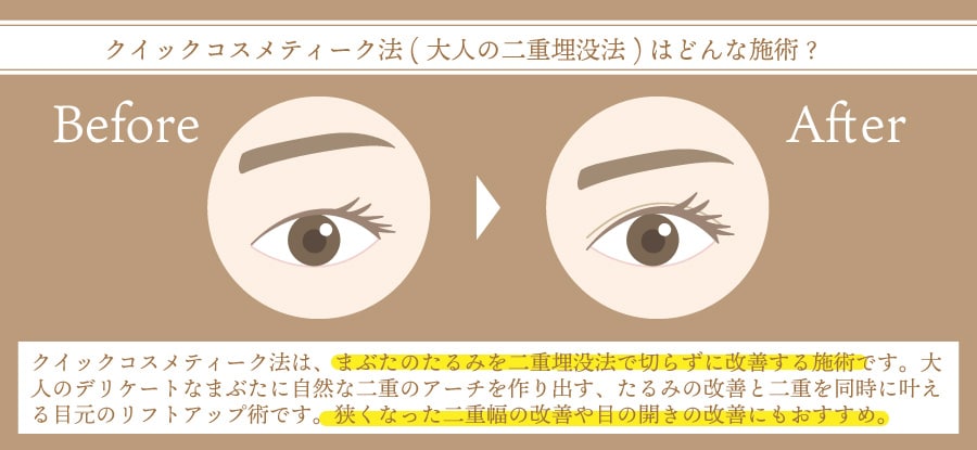 クイックコスメティーク法(大人の二重埋没法)の仕組み解説