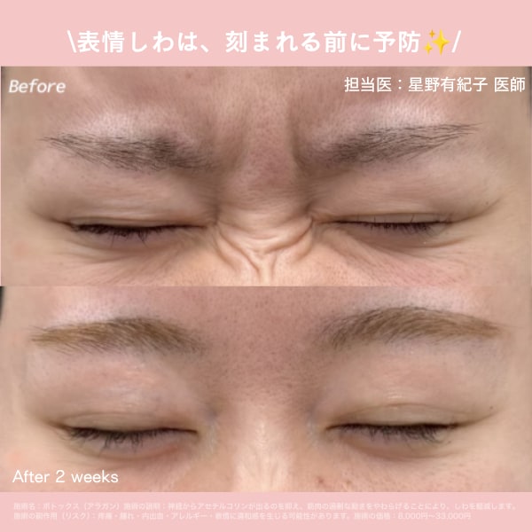 しわ取りボトックス
