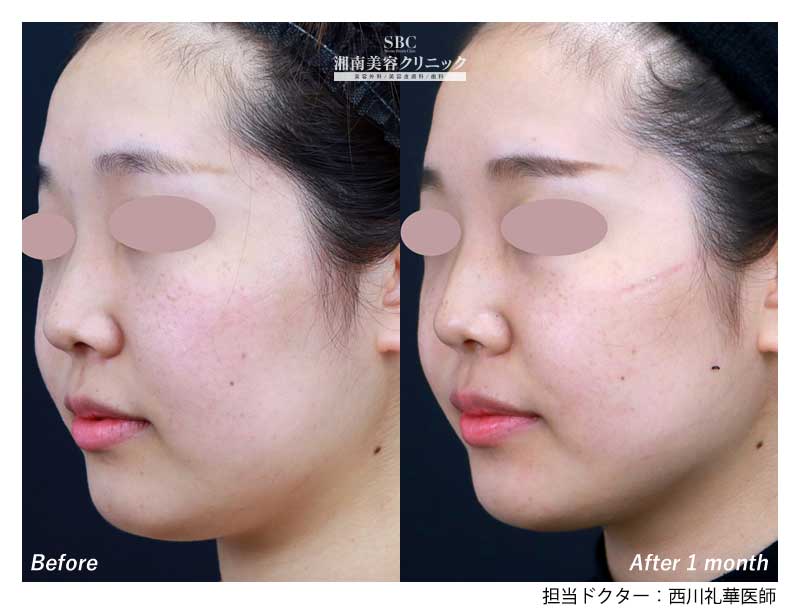 脂肪溶解リニアハイフ 症例写真