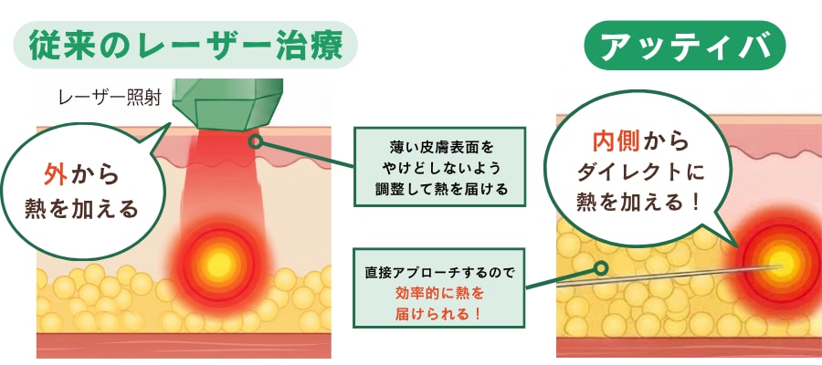 「外から」ではなく「内から」！皮下組織をダイレクトに加熱<br />
