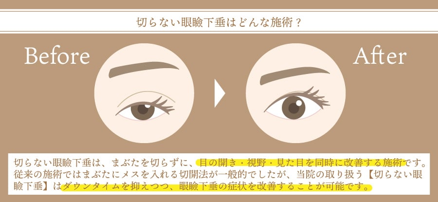 切らない眼瞼下垂の仕組み解説