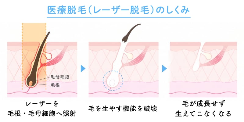 そもそも医療脱毛とは<br />
