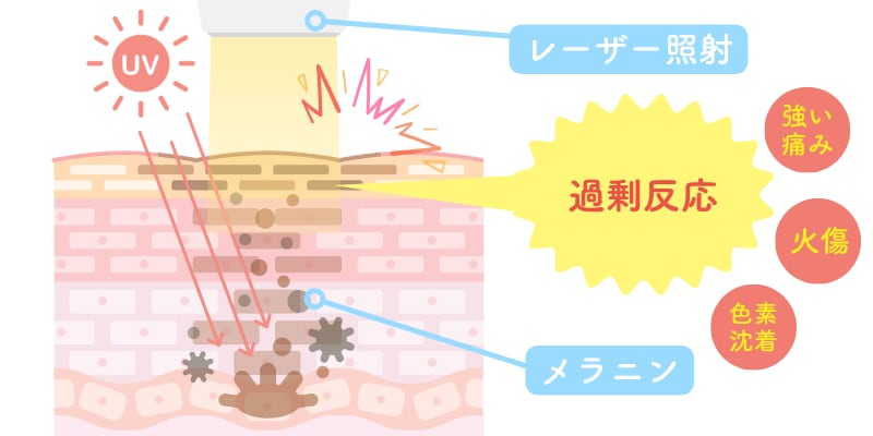 脱毛をしたい、と思ったその日に実行！「日焼け対策」<br />
