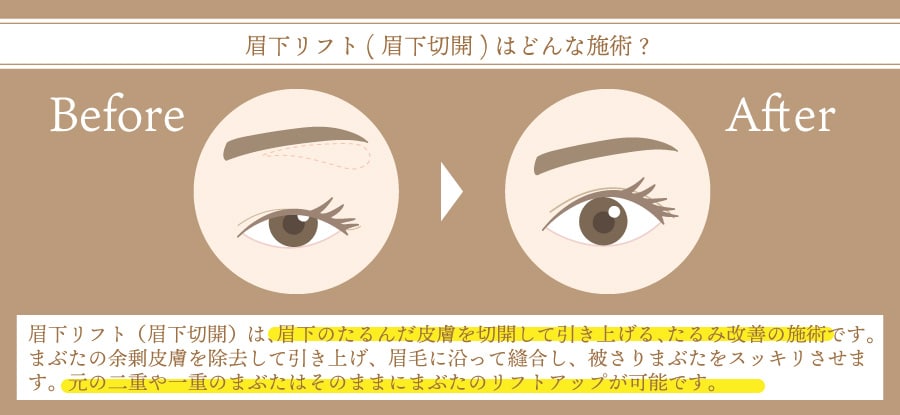 眉下リフト（眉下切開）の仕組み解説