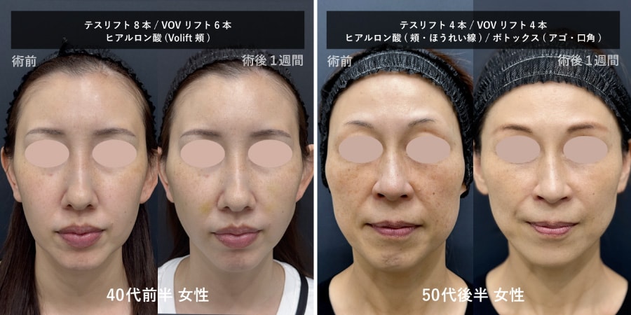 糸リフト術後1週間経過のビフォーアフター症例写真（腫れが引き自然になじんだ様子）