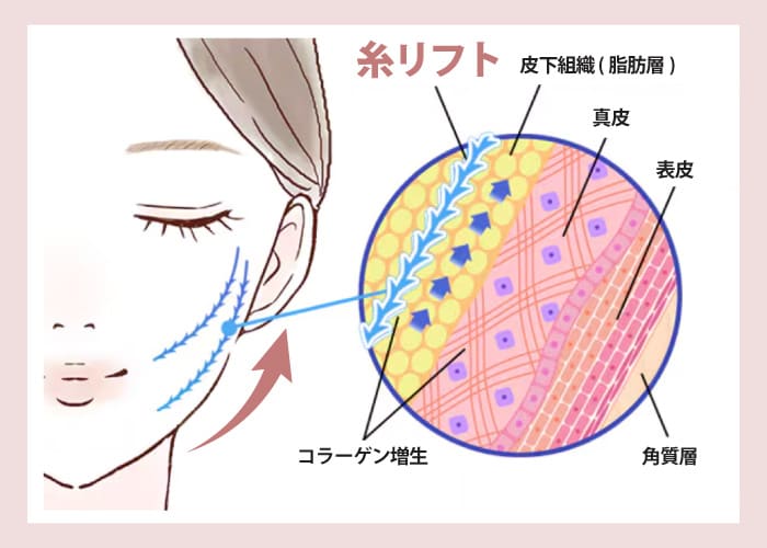 糸リフトの仕組み（皮下組織の脂肪を物理的に持ち上げるイラスト）