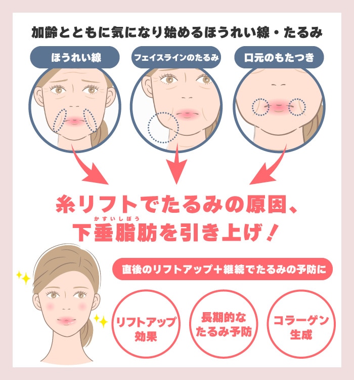 たるみの原因である下垂脂肪を引き上げ！リフトアップとたるみ予防効果のイメージイラスト