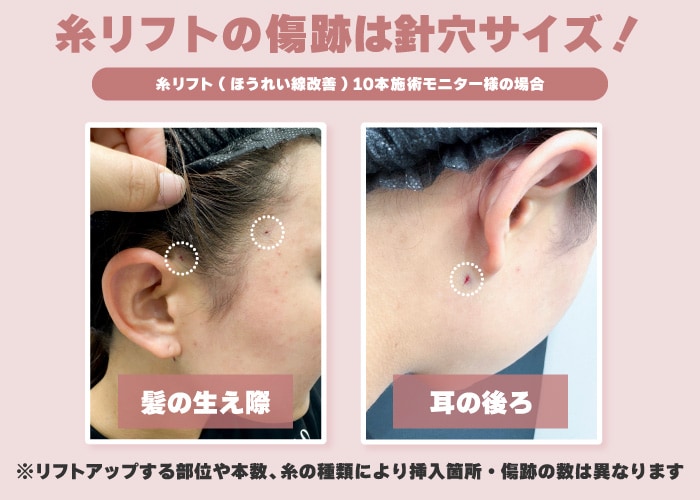 糸リフトの針穴の位置（もみあげの後ろ・髪の生え際など目立たない位置）