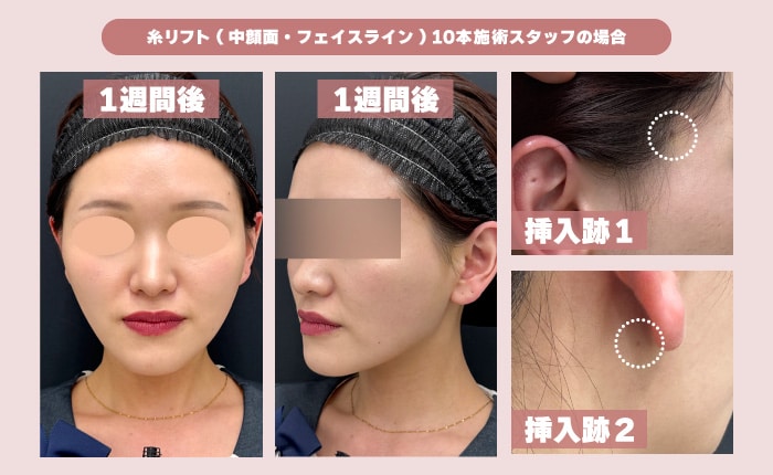 糸リフト術後1週間のダウンタイム経過（内出血の消退と馴染み具合）
