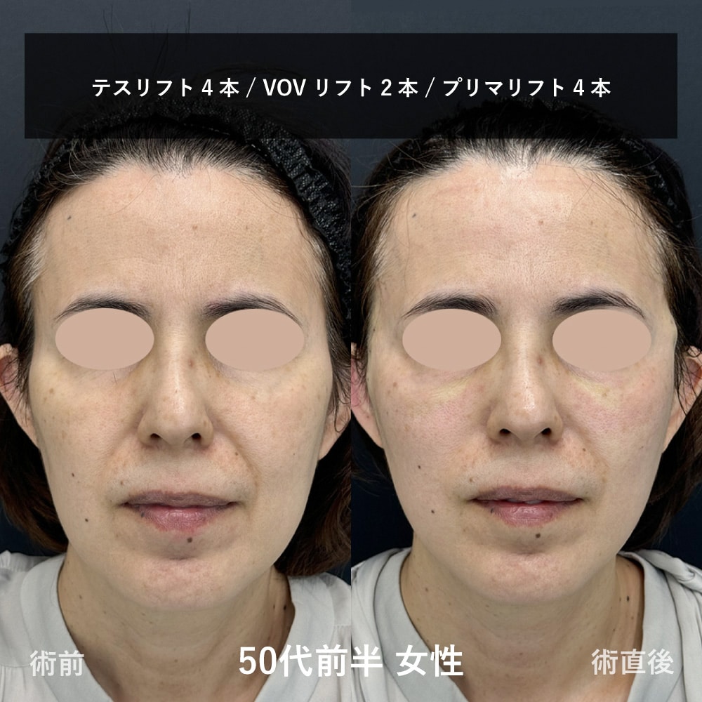 糸リフト症例（ほうれい線改善 症例1）