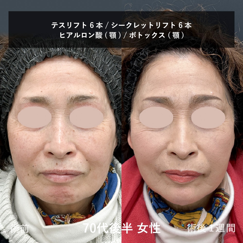 糸リフト症例（フェイスライン・輪郭改善 症例1）