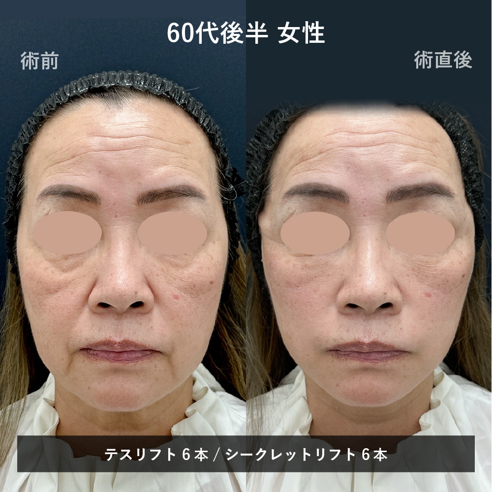 糸リフト症例（ほうれい線改善 症例3）