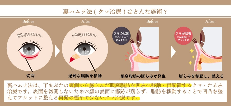 裏ハムラ法（眼窩脂肪移動術）の仕組み解説