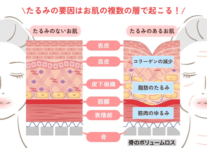 なぜたるみ治療でコンビネーション治療がおすすめなの？
