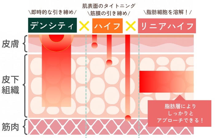 脂肪溶解リニアハイフとのコンビネーションで脂肪にもアプローチ！