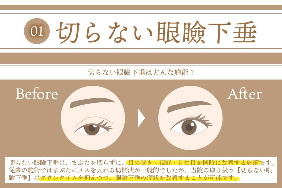 目元のエイジングケア | 切らない眼瞼下垂ってどんな施術？