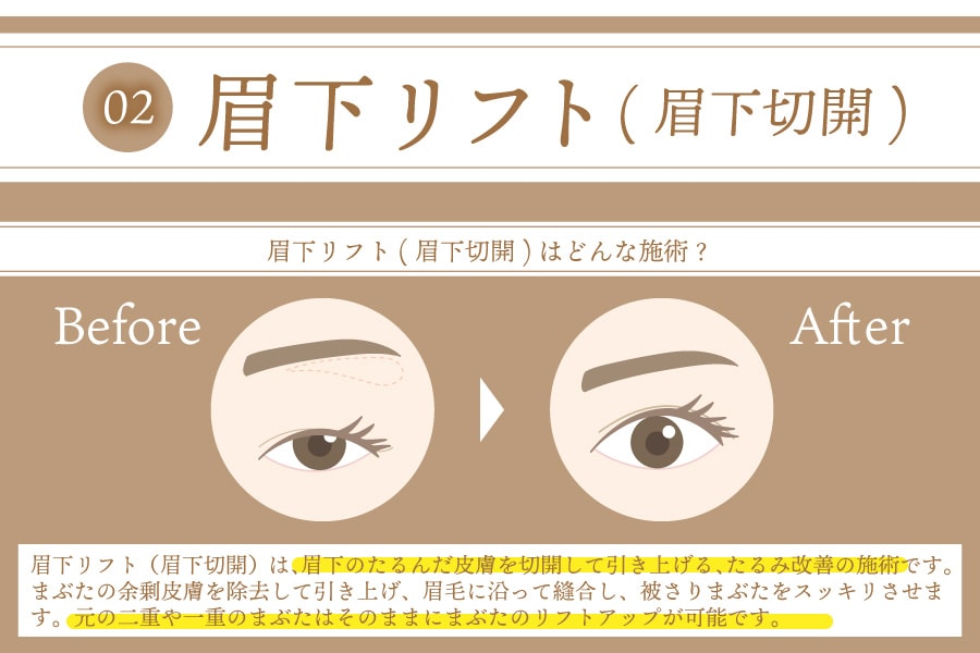 目元のエイジングケア | 眉下リフト(眉下切開)ってどんな施術？