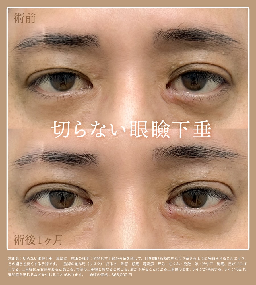 症例写真 | 京都駅ビル院で叶える【切らない眼瞼下垂】