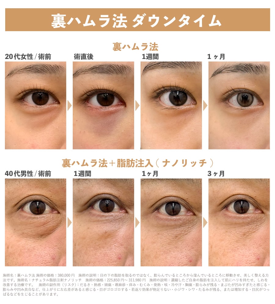 術後の腫れ・内出血の経過と仕事復帰の目安