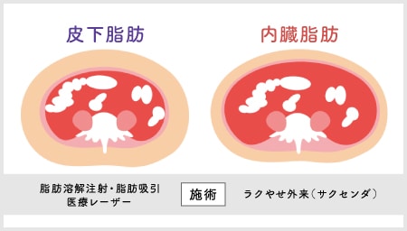 お家で出来る「ラクやせ外来（サクセンダ）」