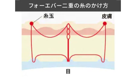 脅威の持続力「フォーエバー二重術」