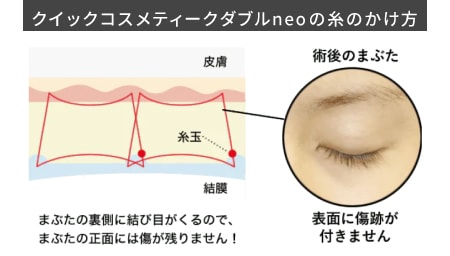 バレづらい腫れづらい「クイックコスメティークダブルneo」