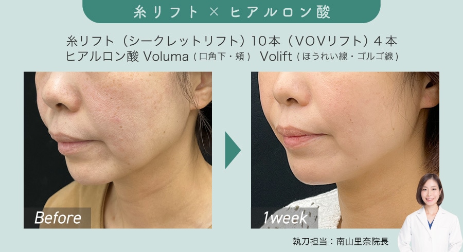 糸リフト×ヒアルロン酸で速攻垢抜け
