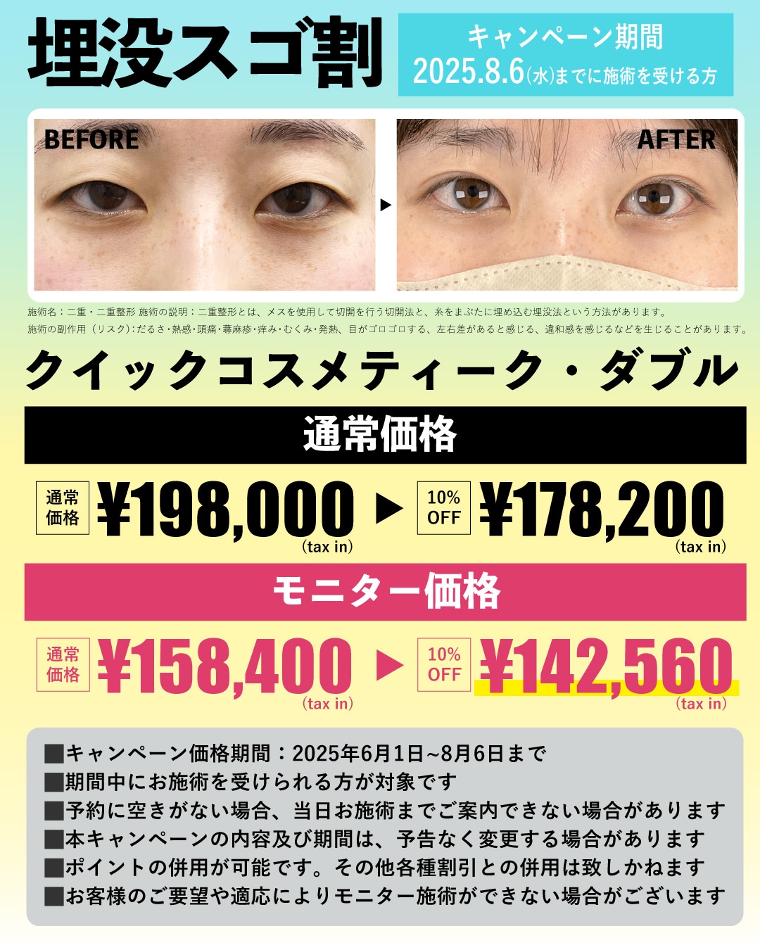 南山医師の埋没法が10%OFF!