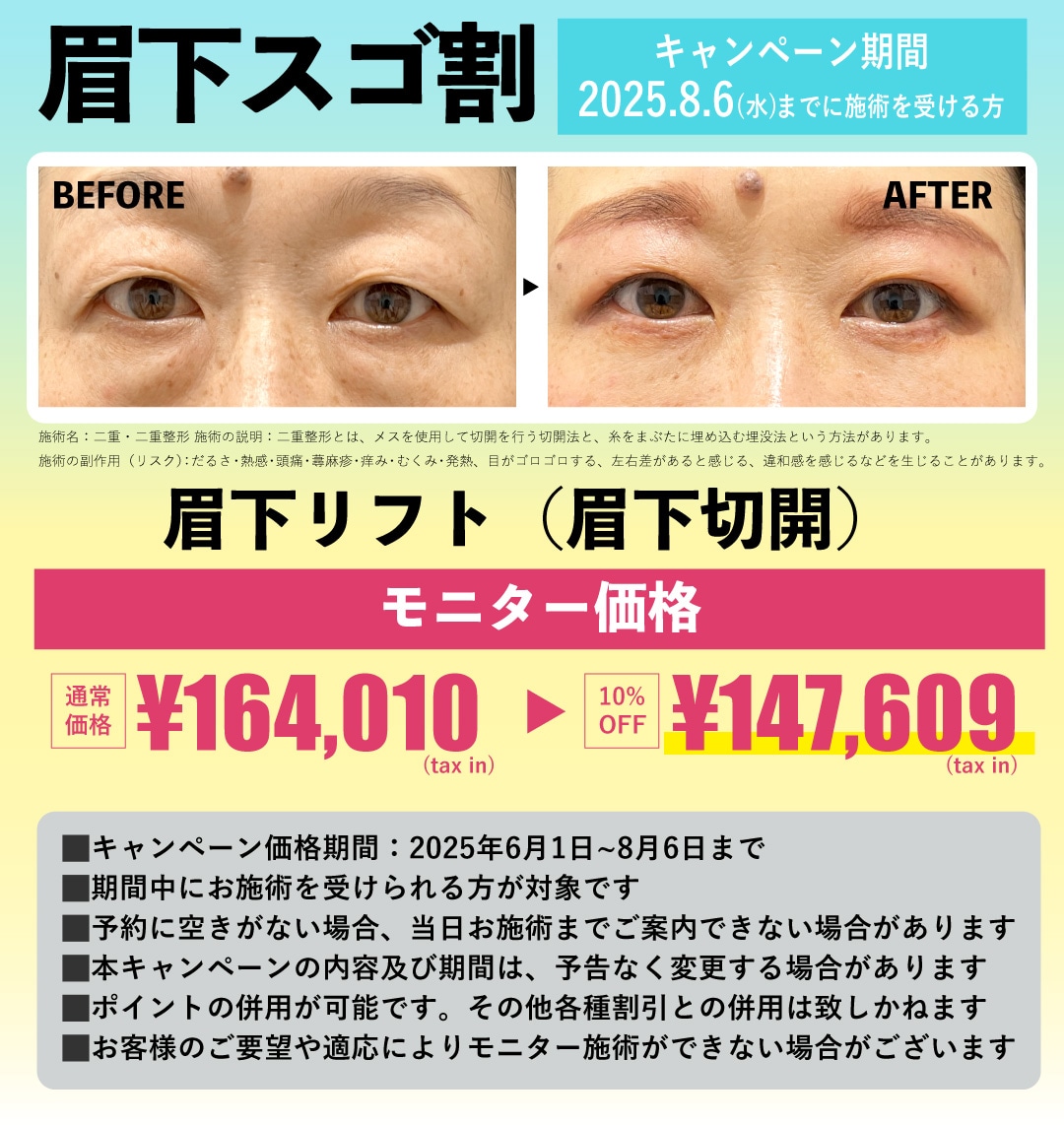 原田医師の眉下リフトが10%OFF!