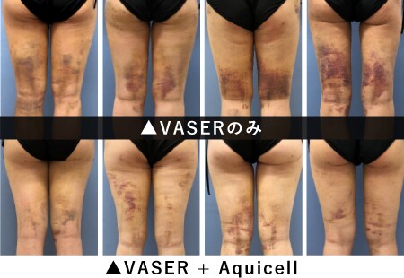 出血量を最小限に抑えてたくさん吸引するために