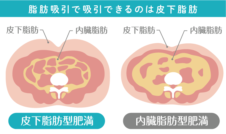 「脂肪吸引」ってどんな施術？