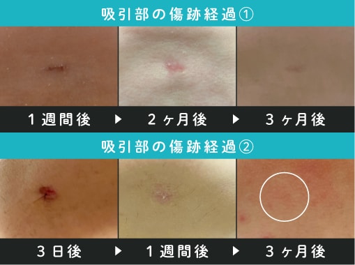 ダウンタイムの目安は？