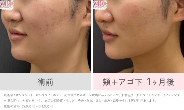 【小顔】<br />
オンダリフト × FatXcore