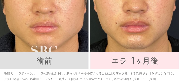 【エラ・小顔】<br />
エラボトックス × FatXcore