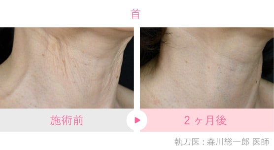 首のしわ」を改善できる新治療登場！肌の土台を再構築する次世代 