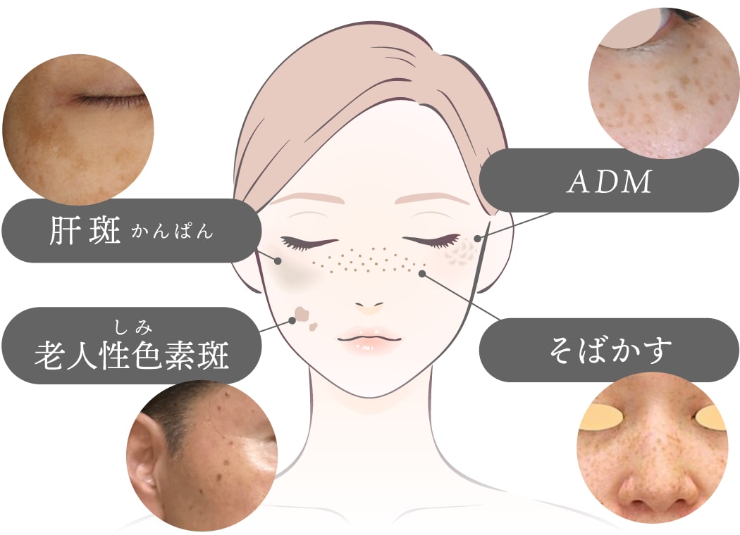 シミの種類と治療方法<br />
